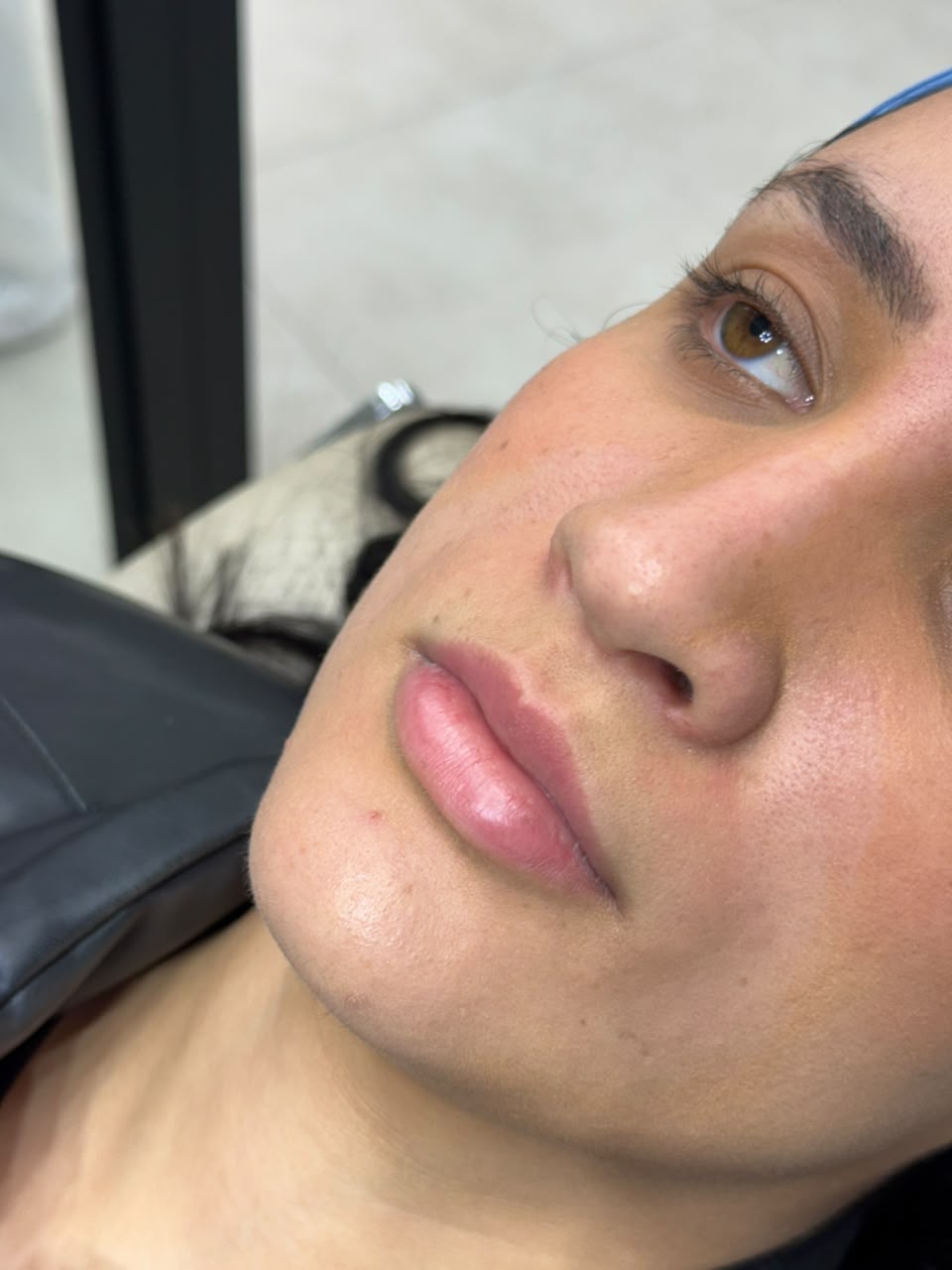 Antes — lábios naturais antes do preenchimento labial