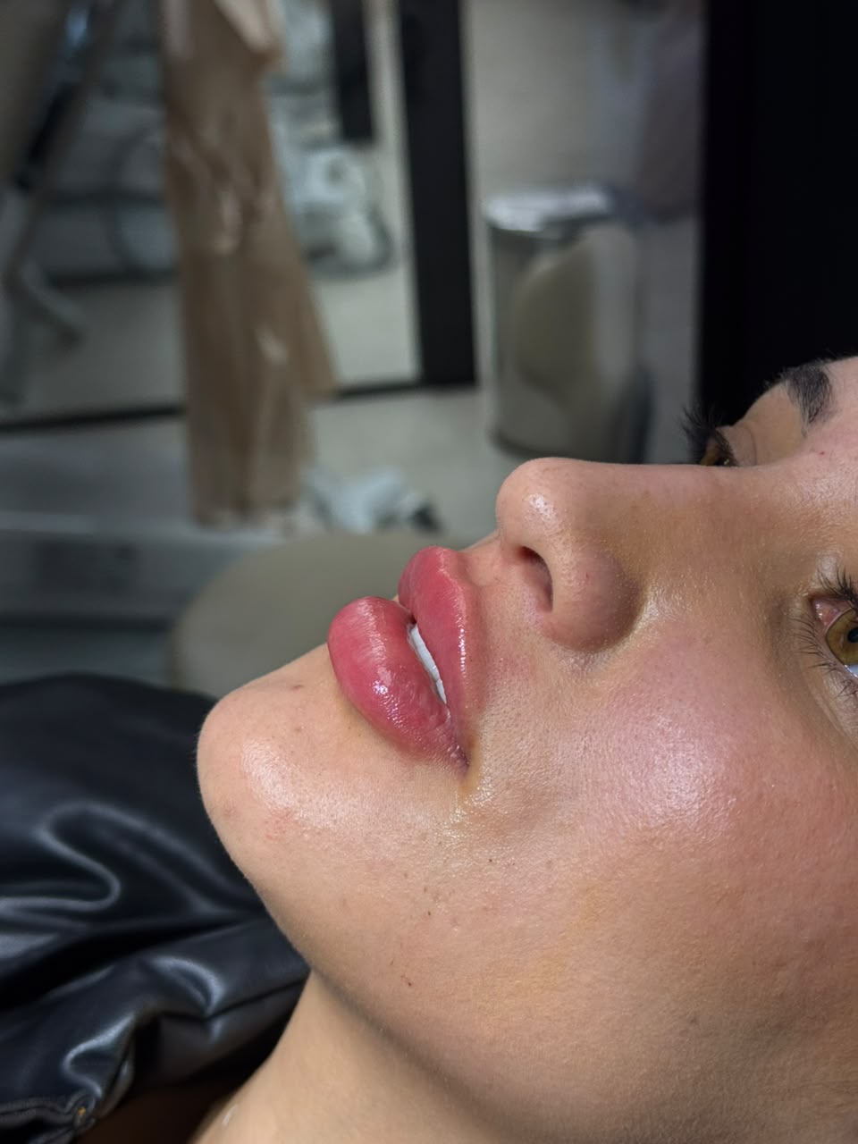 Resultado de preenchimento labial em perfil — projeção e equilíbrio dos lábios