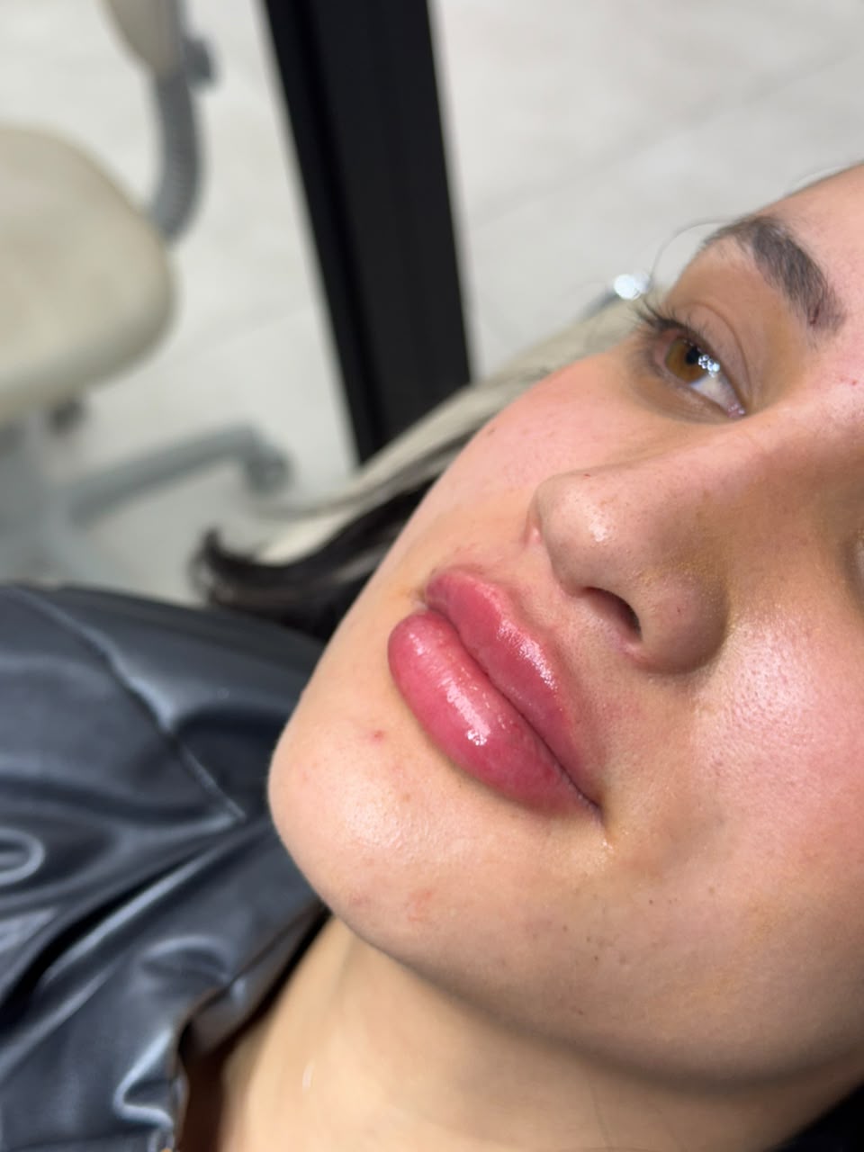 Resultado de preenchimento labial — volume e contorno definidos com ácido hialurônico